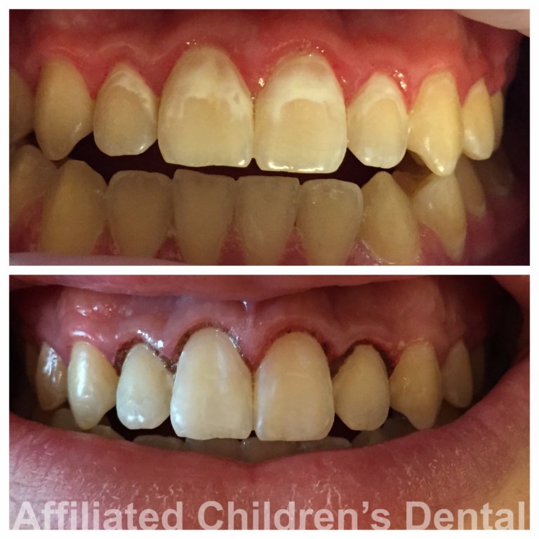 Icon Resin Infiltration (ICON) Affiliated Children's Dental Specialists