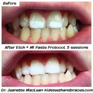 MI Paste Plus - Mint Reverses White Spots In Teeth - With Fluoride 